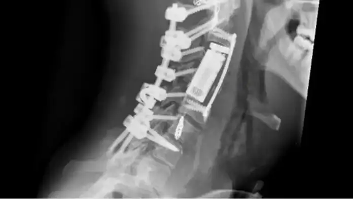 مركز الحسين للسرطان ينجح في إجراء عملية نوعية لاستئصال ورم عنقي معقّد مركز الحسين للسرطان ينجح في إجراء عملية نوعية لاستئصال ورم عنقي معقّد